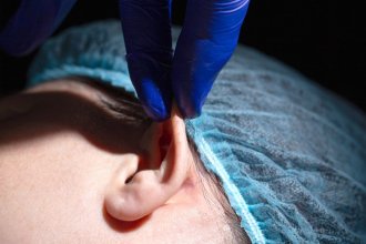 Miniatura Otoplastia: ¿anestesia local o general? Diferencias y recomendaciones | Otoplastia