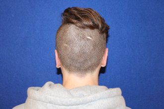 Miniatura Otoplastia cicatriz: dónde queda, cómo evoluciona y qué cuidados necesita