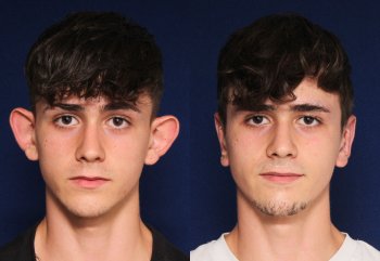 Antes y después de la intervención 2