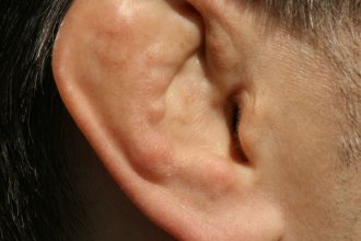 Miniatura Orejas de coliflor: qué son, causas y cómo se corrigen